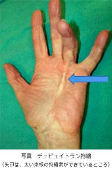 デュピュイトラン拘縮（Dupuytren拘縮）