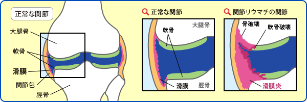 正常な関節　関節リウマチの関節
